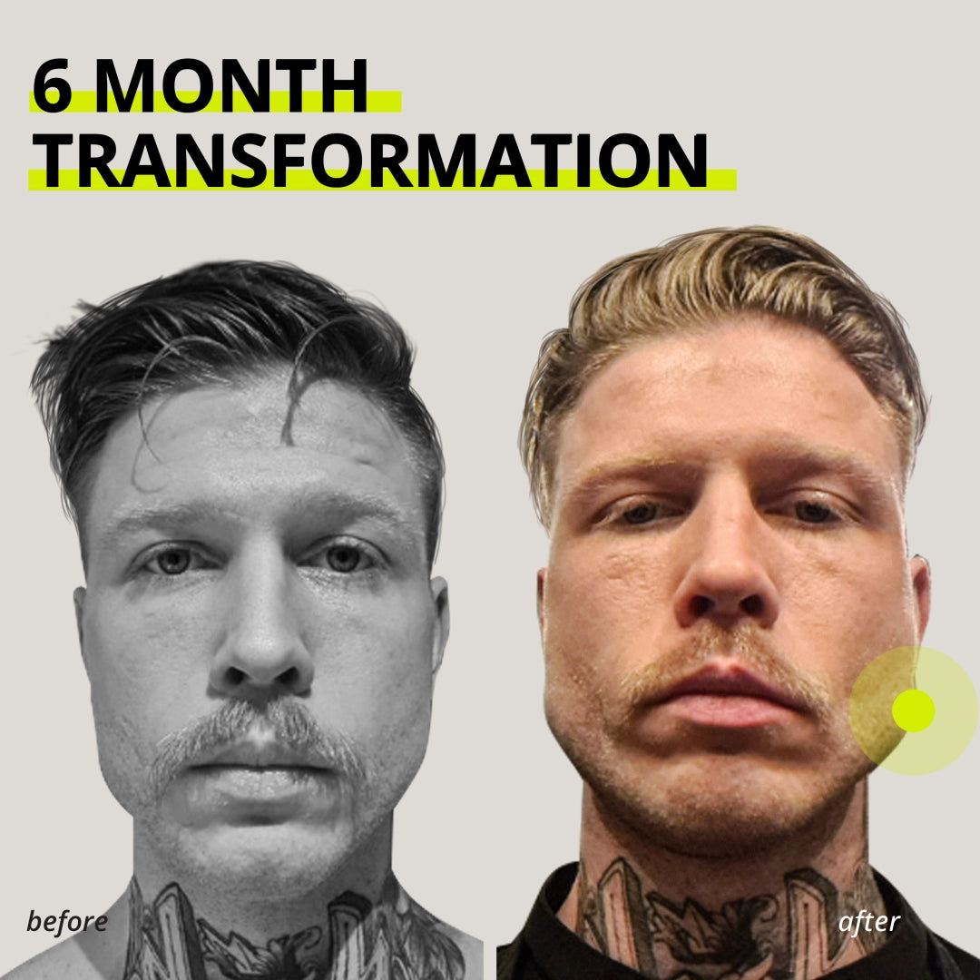 JAWLINER® 3.0 - Elite Edition- Bundle Pack