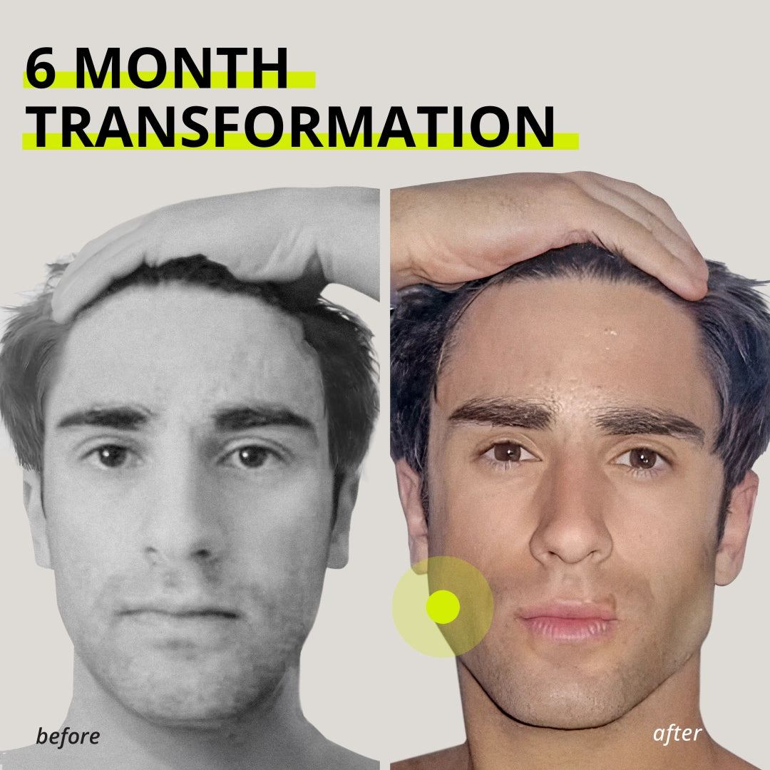 JAWLINER® 3.0 - Elite Edition- Beginner