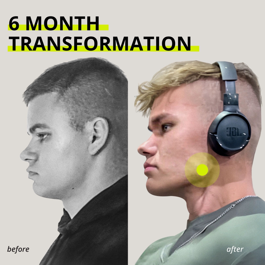 JAWLINER® 3.0 - Elite Edition- Bundle Pack